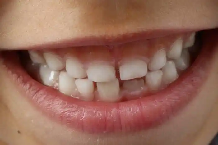 Tahukah Kalian Bahwa Buah Strawberry Memiliki Fungsi Dalam Memutihkan Gigi?